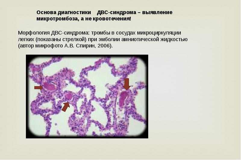 Двс синдром презентация