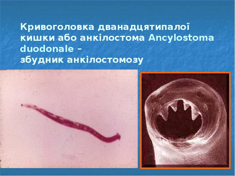 Кривоголовка дванадцятипалої кишки або анкілостома Ancylostoma duodonale –  збудник анкілостомозу