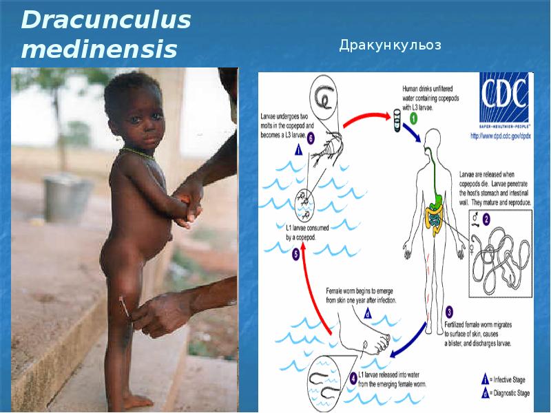 Dracunculus medinensis