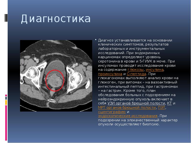 Нейроэндокринная опухоль симптомы