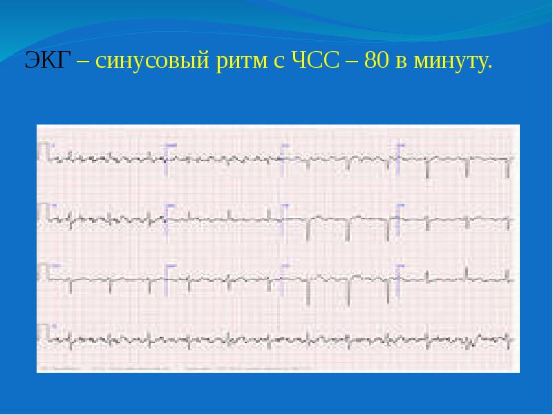 ритм синусовый чсс 85. чсс на экг при трепетании. синусовая аритмия с чсс 80-100 уд/мин. кардиограмма сердца расшифровка синусовый ритм норма. экг сердца расшифровка синусовый ритм.