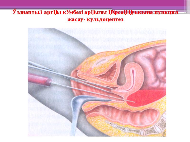Қынаптың артқы күмбезі арқылы құрсақ қуысына пункция жасау- кульдоцентез Қынаптың артқы күмбезі арқылы құрсақ қуысына пункция жасау- кульдоцентез