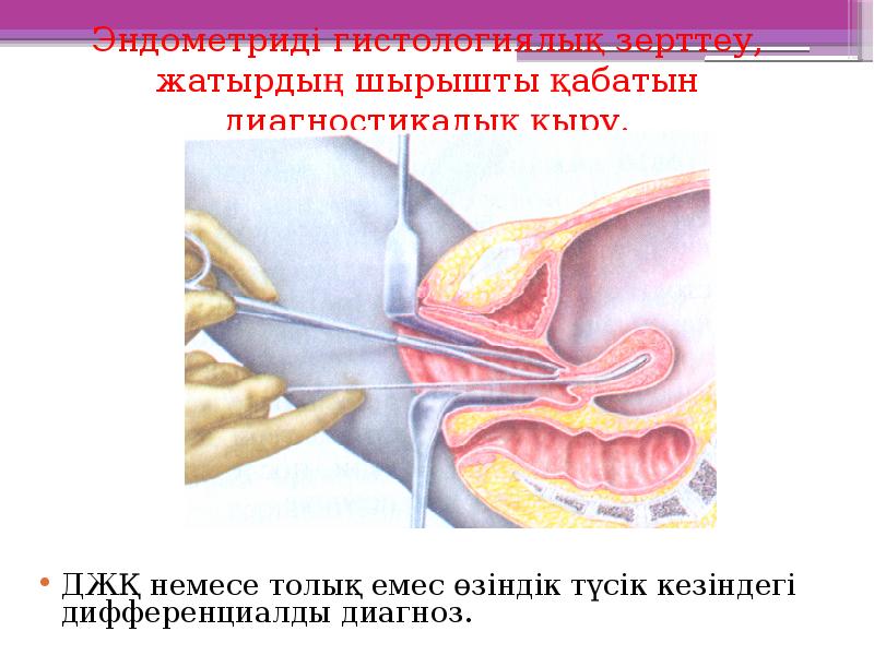 Эндометриді гистологиялық зерттеу, жатырдың шырышты қабатын диагностикалық қыру.
ДЖҚ немесе толық Эндометриді гистологиялық зерттеу, жатырдың шырышты қабатын диагностикалық қыру.
ДЖҚ немесе толық