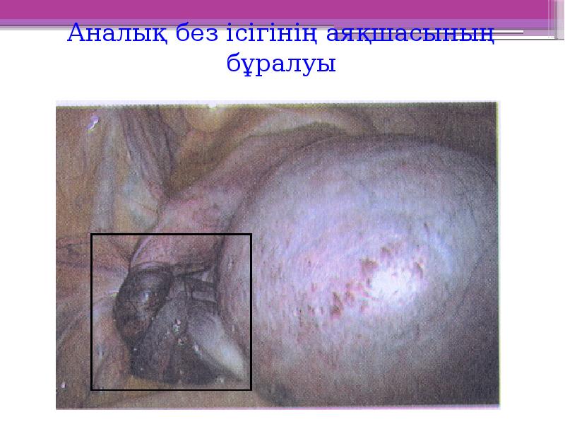 Аналық без ісігінің аяқшасының бұралуы Аналық без ісігінің аяқшасының бұралуы