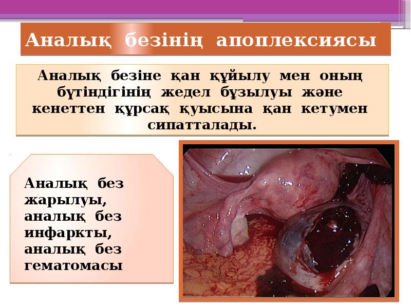 Аналық безінің апоплексиясы Аналық безінің апоплексиясы