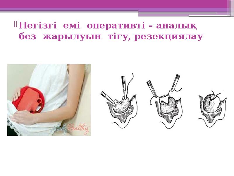 Негізгі емі оперативті – аналық без жарылуын тігу, резекциялау Негізгі емі оперативті – аналық без жарылуын тігу, резекциялау