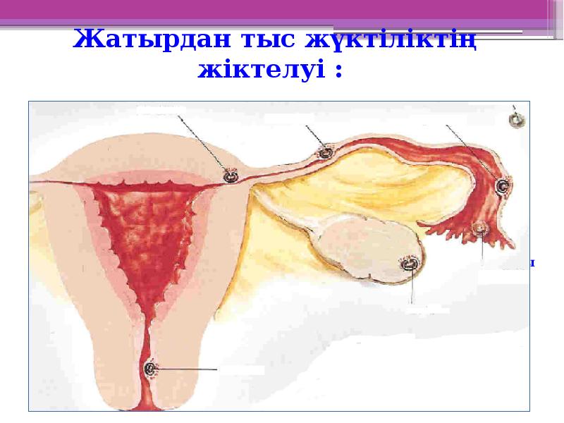 Жатырдан тыс жүктіліктің жіктелуі : Жатырдан тыс жүктіліктің жіктелуі :