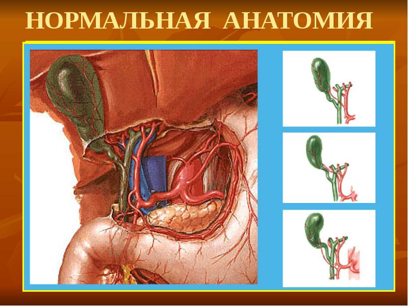 Жіті холецистит презентация