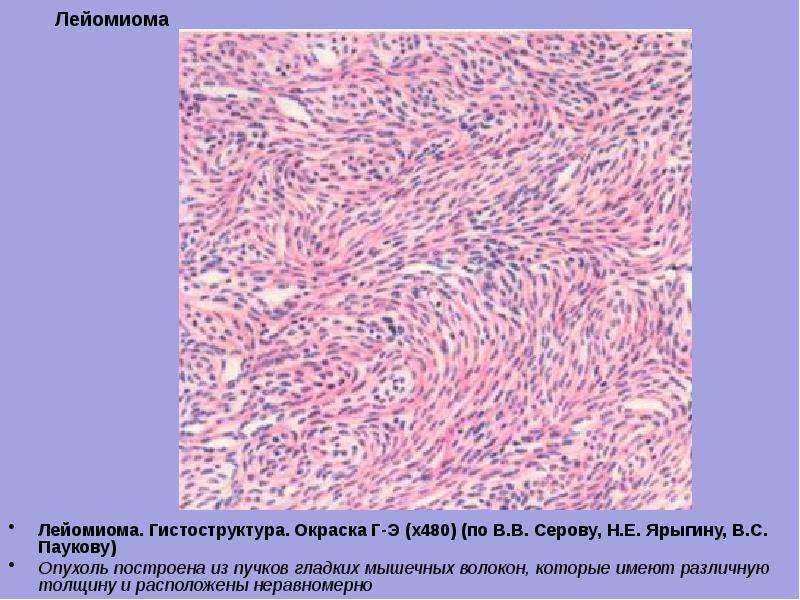 Лейомиома стенки пищевода микропрепарат рисунок