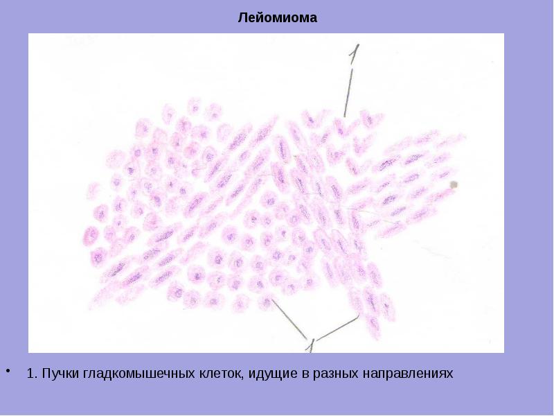 Лейомиома стенки пищевода микропрепарат рисунок