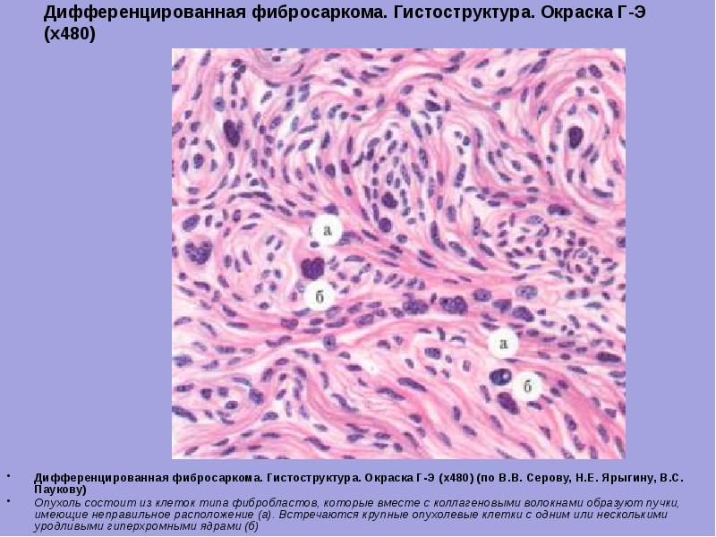 Фиброма микропрепарат рисунок