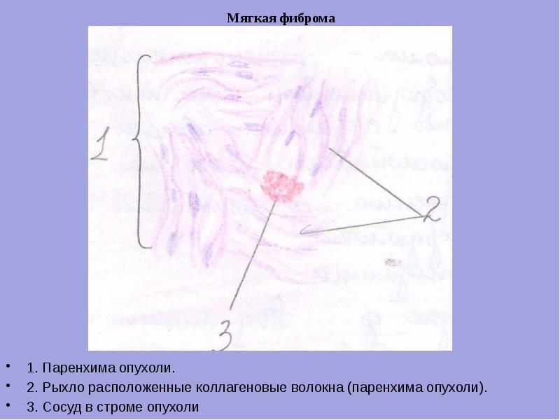 Лейомиома стенки пищевода микропрепарат рисунок