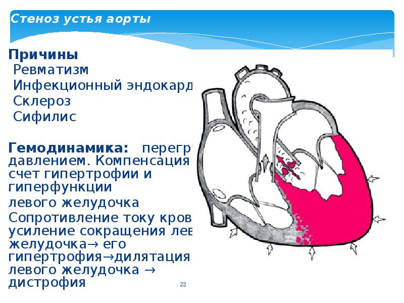 Сердечный стеноз. Митральный стеноз сердца гемодинамика. Стеноз устья аорты и аортальный стеноз. Клинические проявления при стенозе устья аорты.