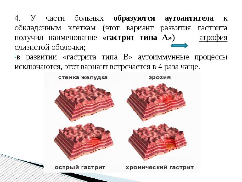 Презентация на тему острый гастрит